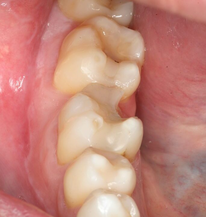 corona dental benicarlo zirconio