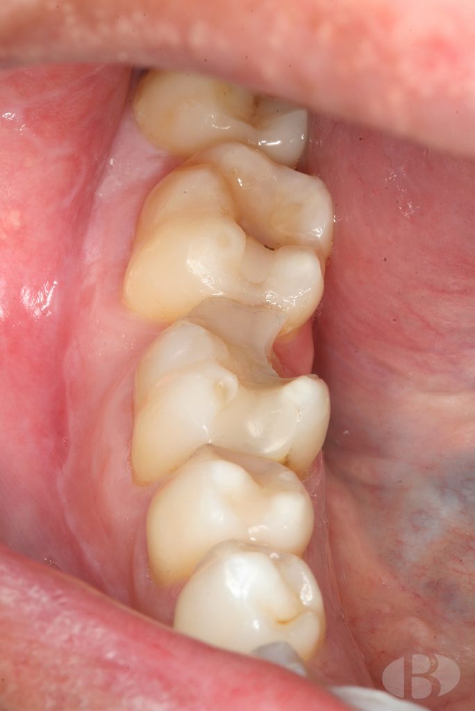 corona dental benicarlo zirconio