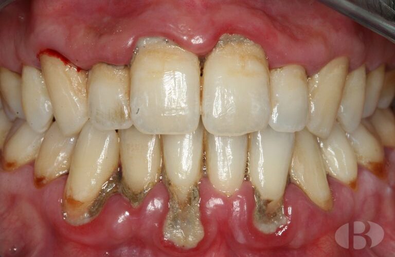 periodontis enfermedad periodontal encia sangrado