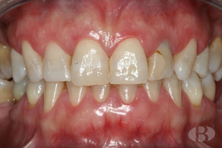 protesis dental estetica de ceramica