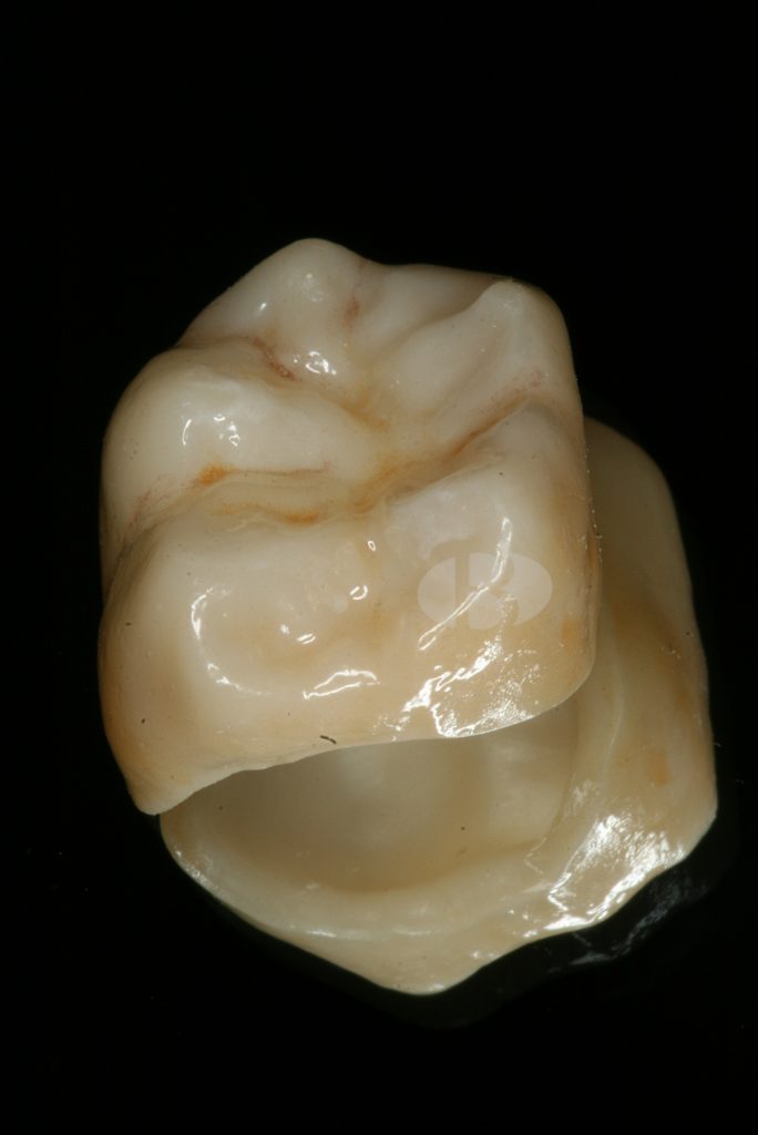 corona dental beniarlo zirconio