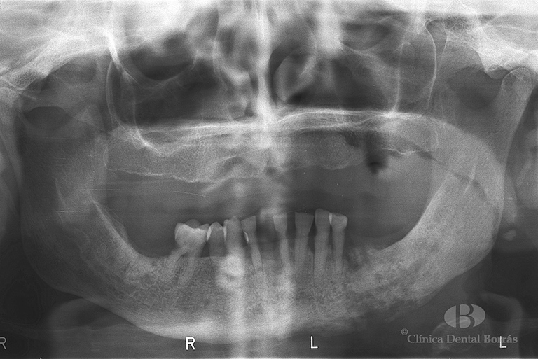 radiografia dientes
