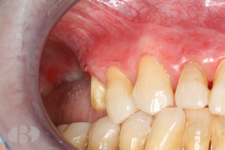 penfigoide mucosa oral bucal