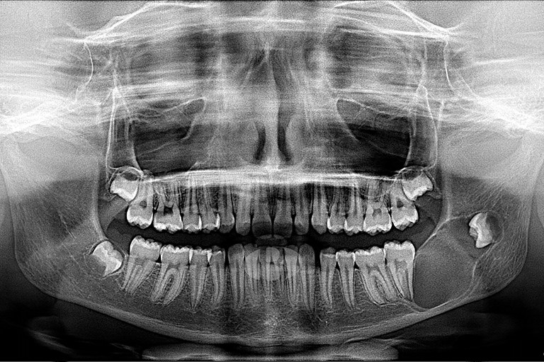 queratoquiste odontogenico marsupializacion