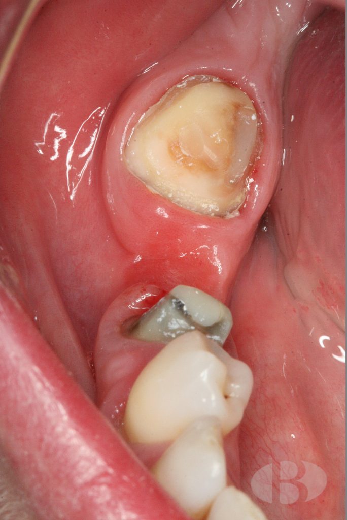 dientes pilarees
