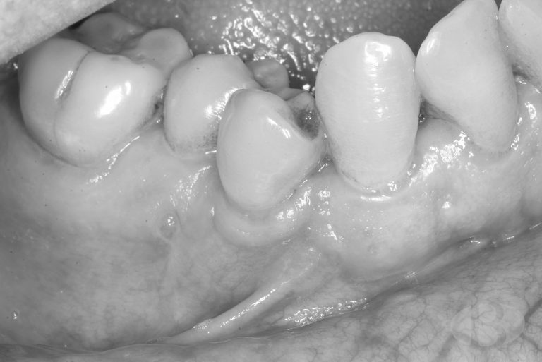 recuperacion de dientes despues de cirugia